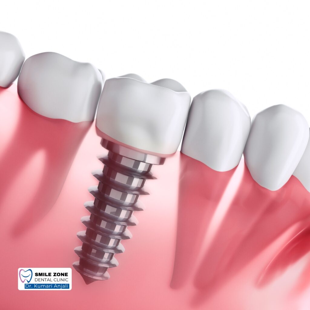 dental implant